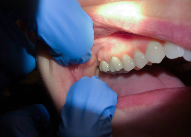 Best Emergency Dentist for Knocked-Out Tooth in Sidney, OH